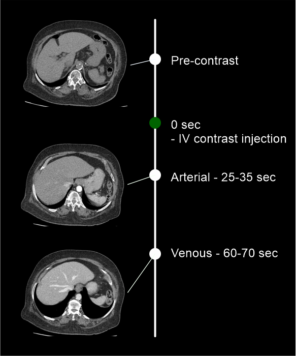 Demonstrates different phases in CT mesenteric angiogram scan.