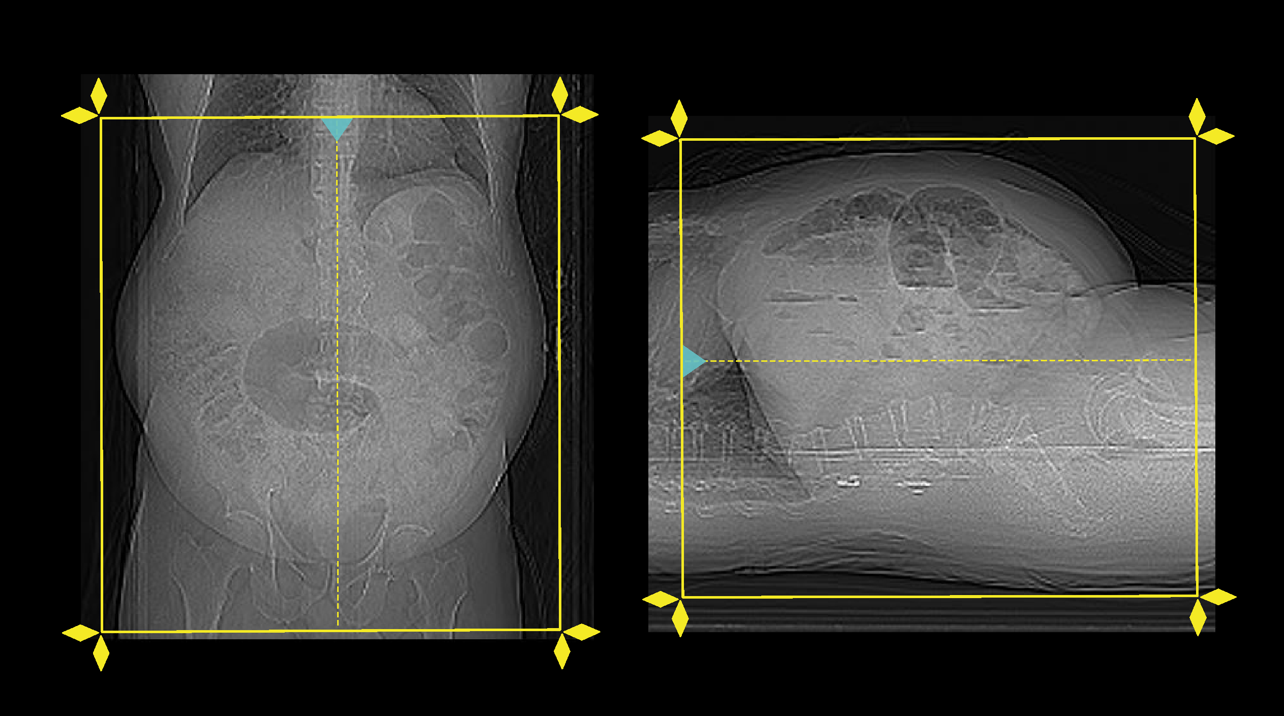 Demonstrates scan slab planning for CT mesenteric angiography.