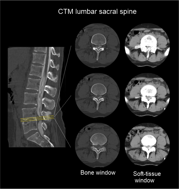 CTM axial images of lumbar sacral spine show L4-L5 spinal cord compression.