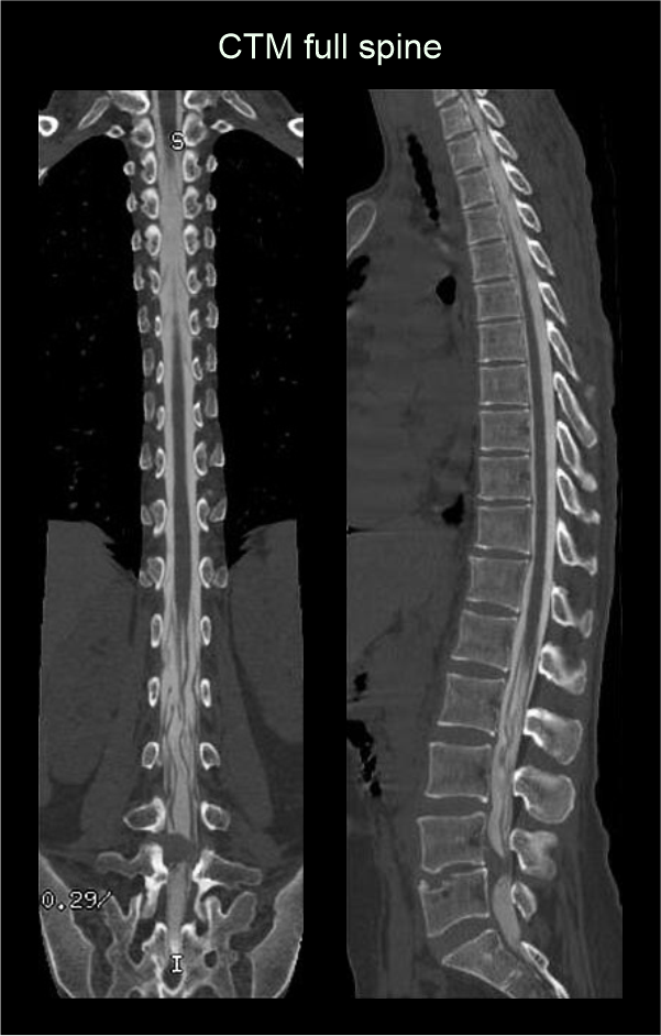 CECT myelogram images demonstrate iodinated contrast filled subarachnoid space of spine.