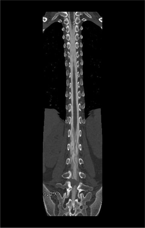 CT myelogram image shows Iodinated contrast filled subarachnoid space of spine.