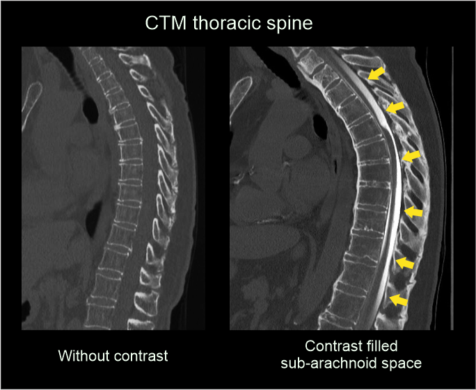 CT myelogram images demonstrate subarachnoid space with and without iodinated contrast.