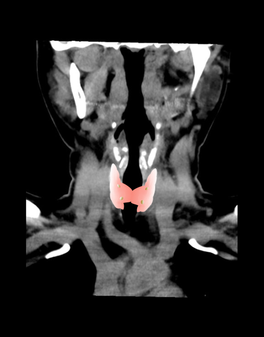 Altered image of CT parathyroid scan, demonstrating thyroid and parathyroid glands.