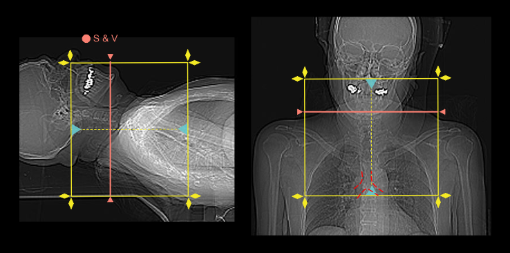 Demonstrates scan slab and bolus-track slice planning for CT 4D neck scan.