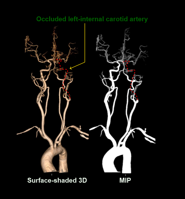 Demonstrates surface shaded and maximum intensity (MIP) images of CT neck vessels, and this patients' left-internal carotid artery is occluded.