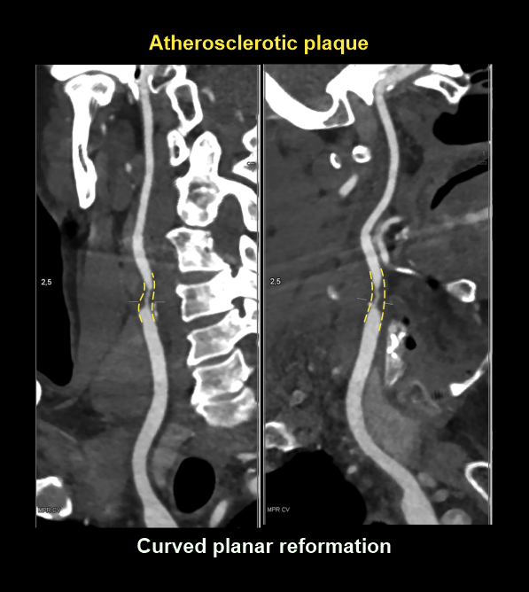Demonstrates curved planer reformation (CPR) of carotid arteries showing atherosclerotic plaque. Images are from a cervicocerebral CTA.