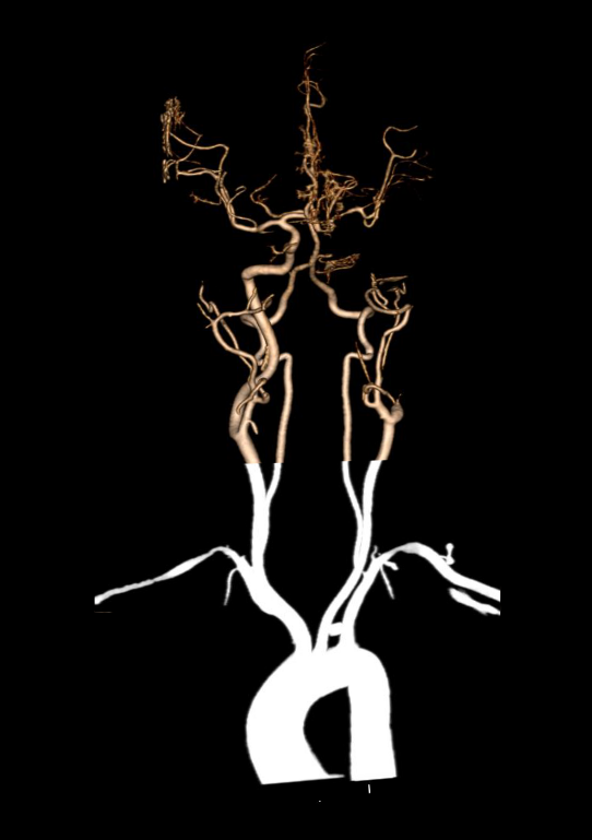 Altered images of CT carotid angiogram.
