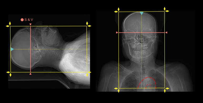 Demonstrates scan slab and bolus tracking slice planning for CT neck angiogram.