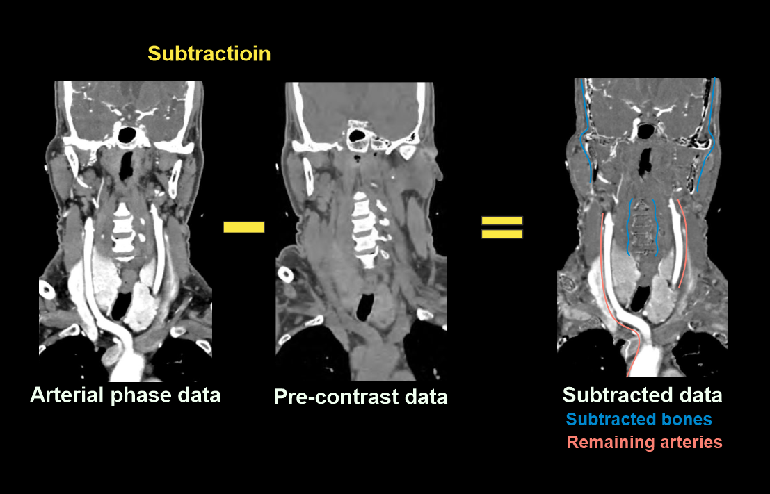 Image explains subtraction of pre and post contrast images to get angiogram. Images are form a CT head and neck angio.