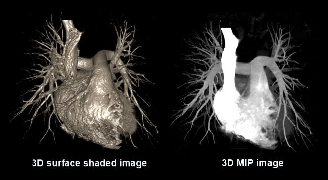 3D surface shaded (left) and MIP (right) images of CTPA.