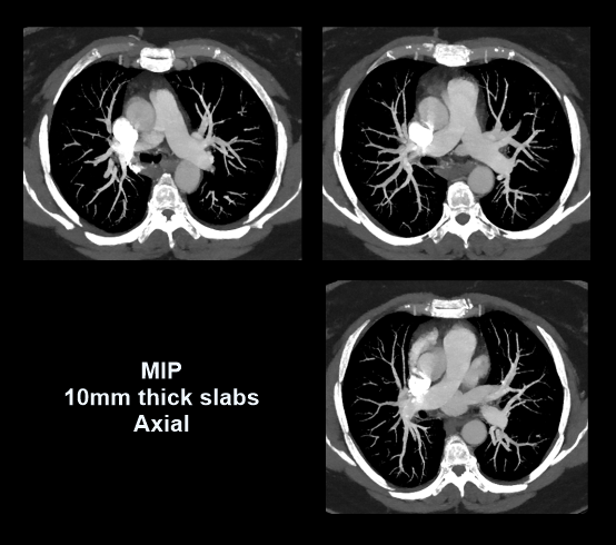 Maximum intensity projection images of CT pulmonary angiogram.