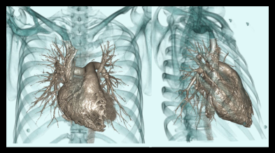 Laired surface shaded images of CT pulmonary angiography.