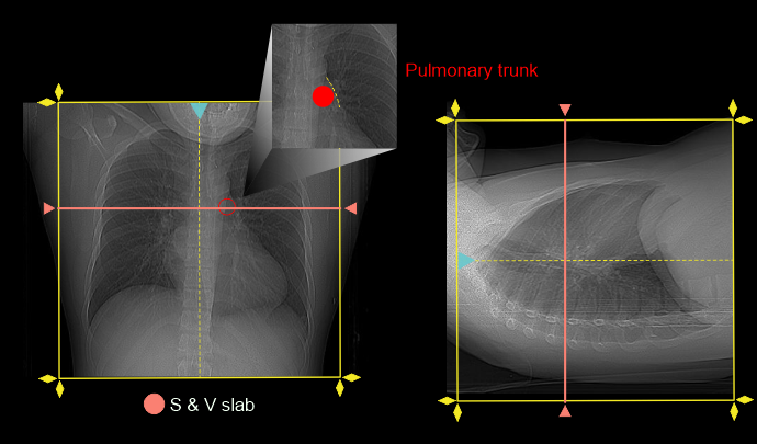Demonstrates S & V slice placement and scan slab planning for CTPA scan.
