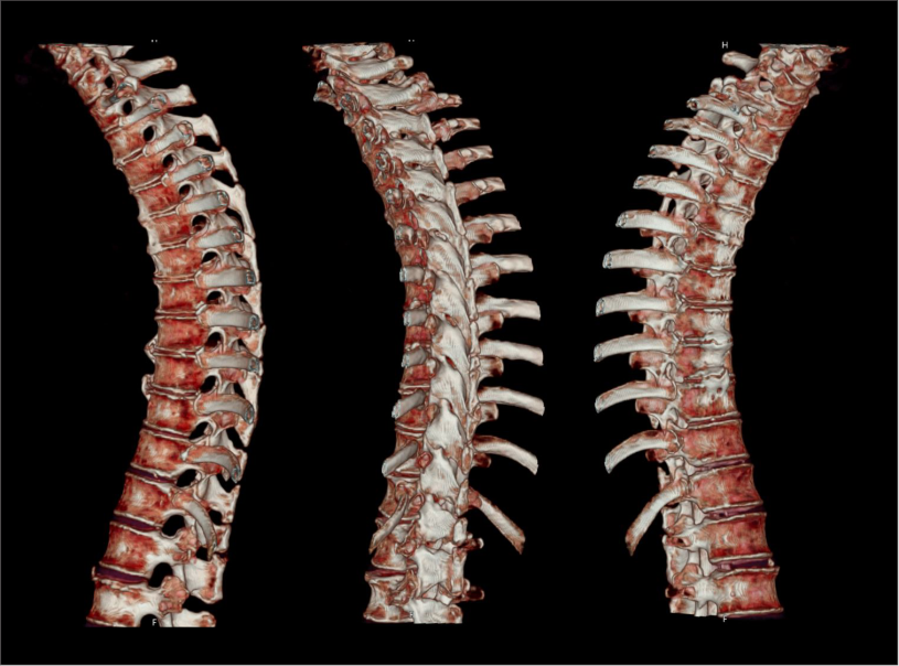3D surface shaded images of CT Thoracic spine.