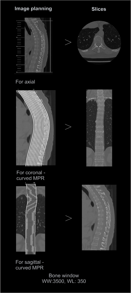 Multi planar reformation (MPR) of CT thoracic spine protocol.