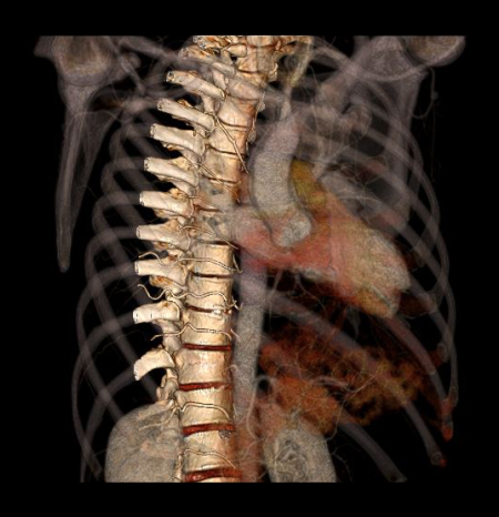 Layered 3D surface rendered images of a CT thoracic spine scan.