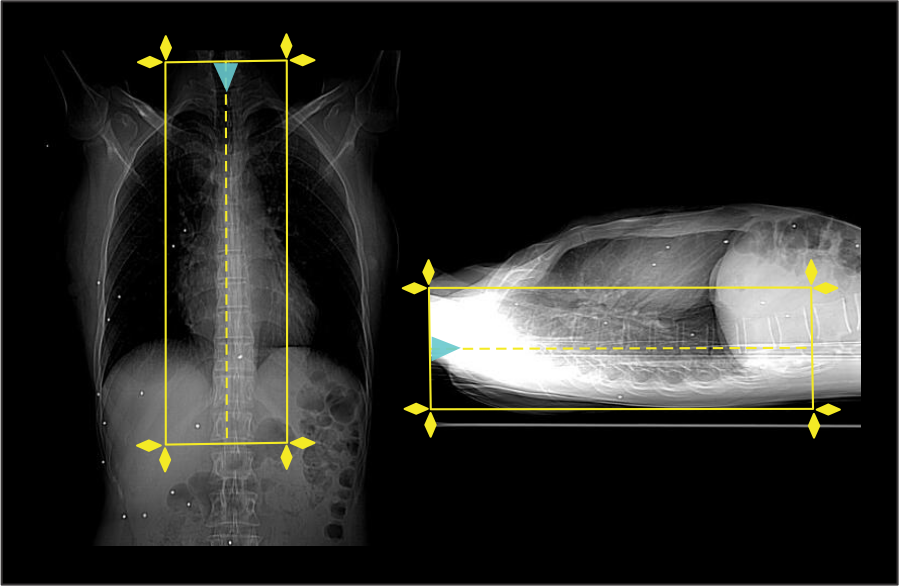Demonstrates scan planning for CT Thoracic spine scan.
