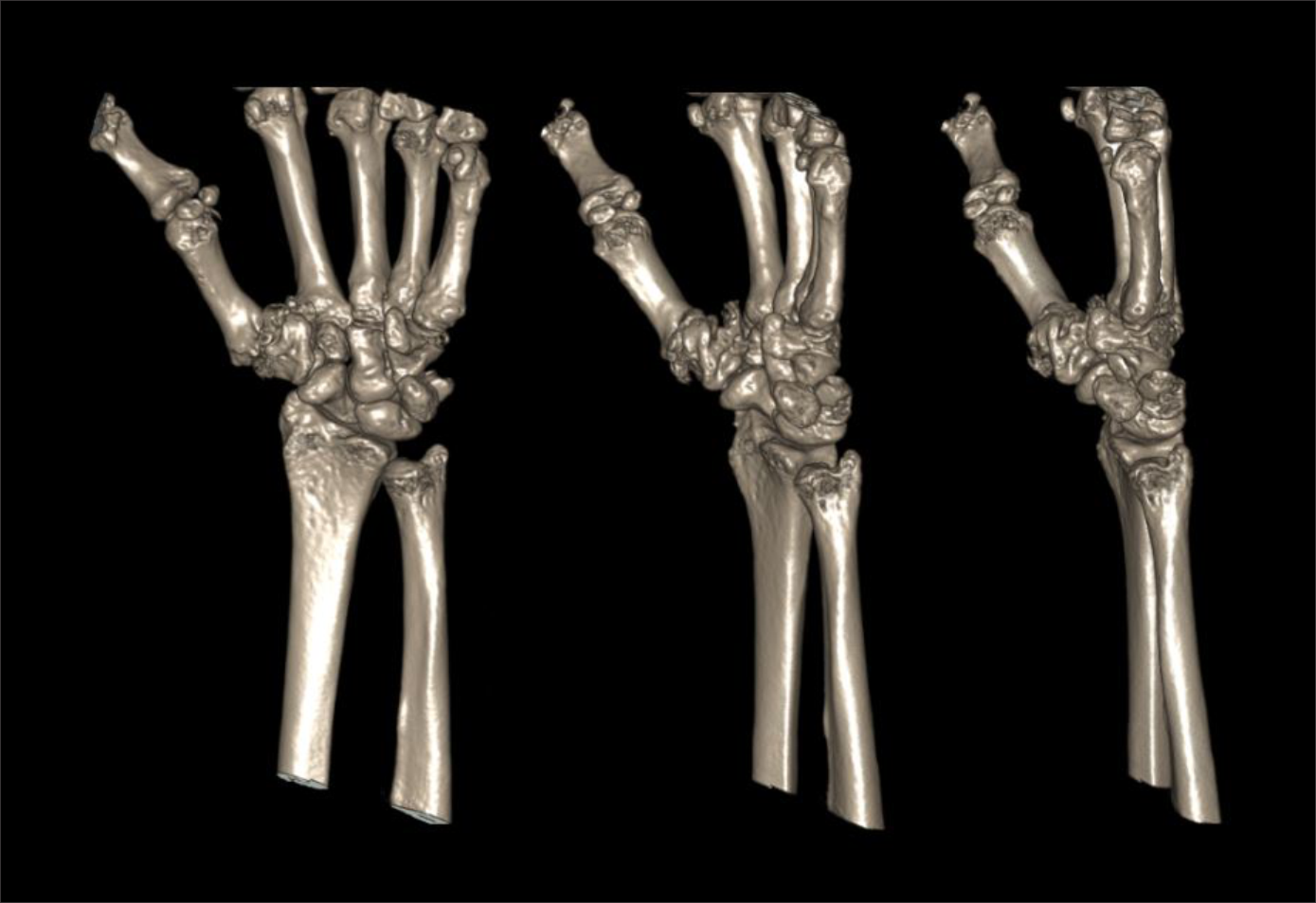 Demonstrates surface rendered images of a CT wrist scan.