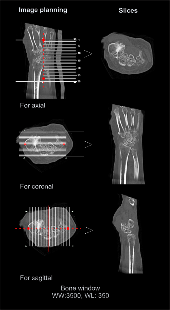 Multiplanar reformation (MPR) for CT wrist joint scan.
