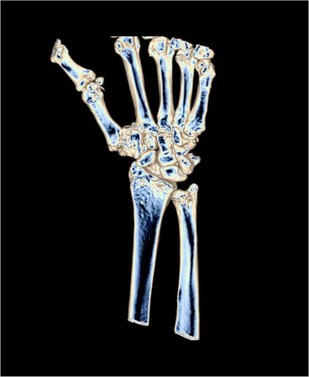 Altered 3D images of a CT wrist joint scan.