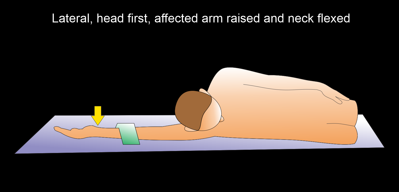 Illustration demonstrates patient positioning for CT wrist scan - positioned in lateral, head first, flexed neck and raised affected arm.
