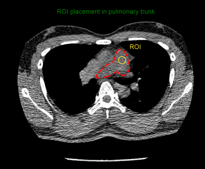 Demonstrates CTPA ROI placement in the pulmonary trunk.
