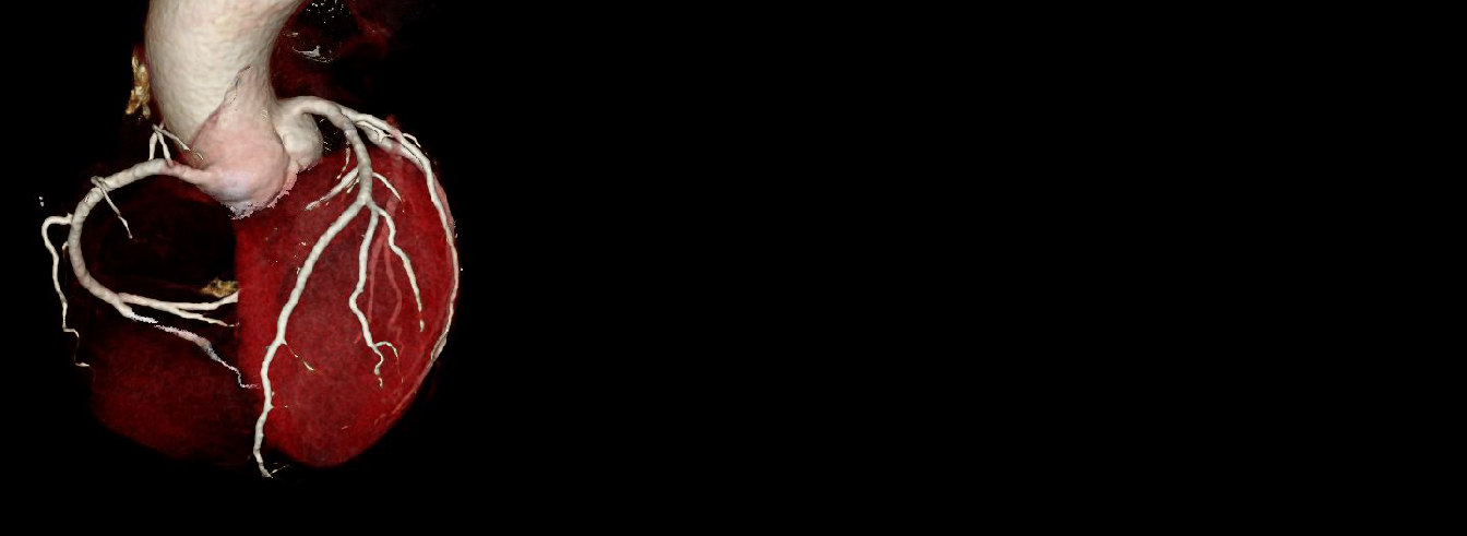 3D Surface shaded display image of coronary arteries of the heart