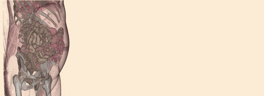 CT Abdomen study shows bowels in the abdominal cavity