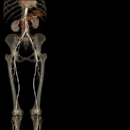 3D surface shaded image shows arteries of the lower limbs