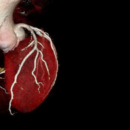 3D Surface shaded display image of coronary arteries of the heart