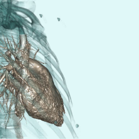 CT Pulmonary angiogram shows the heart along with pulmonary arteries