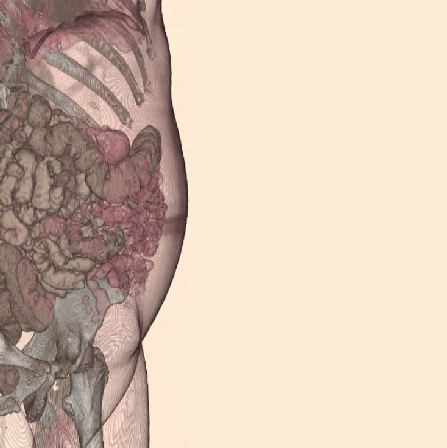 CT Abdomen study shows bowels in the abdominal cavity