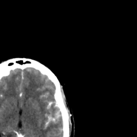 Image of a CT brain scan