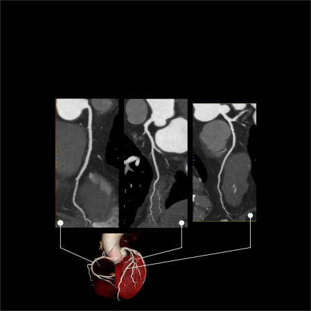 Images of a CT coronary angiogram showing major coronary arteries