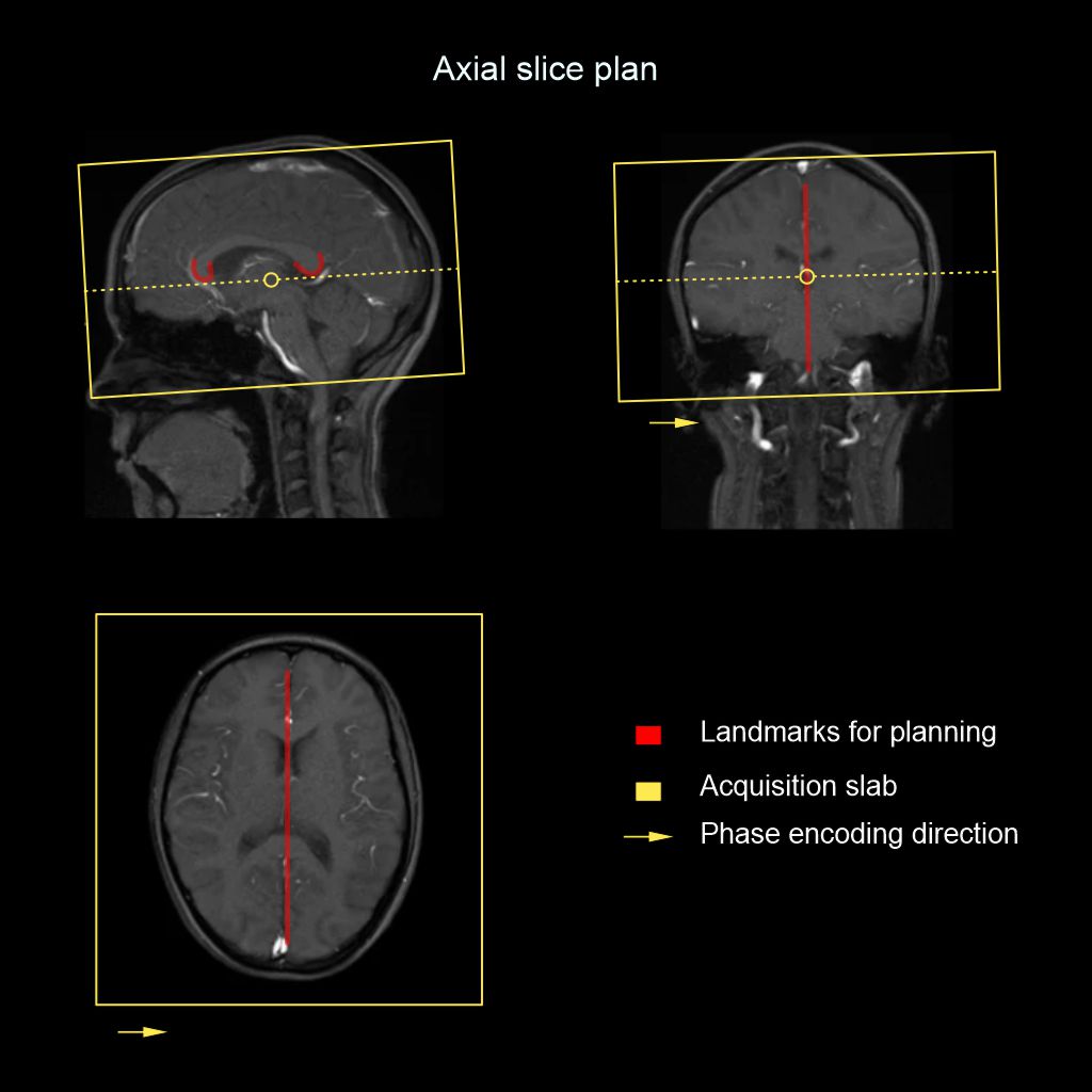 Demonstrates the planning for MRI Brain axial slices