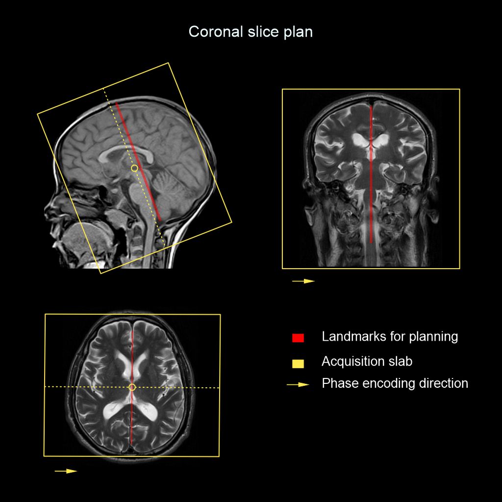 Demonstrates the planning for MRI Brain coronal slices