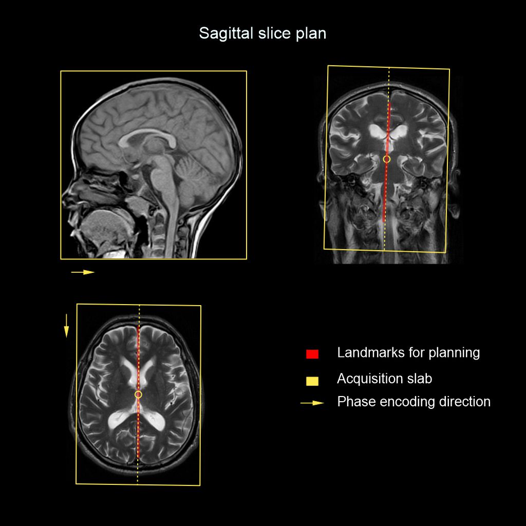 Demonstrates the planning for MRI Brain sagittal slices