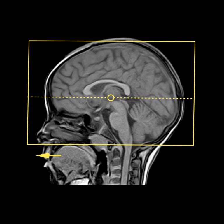 Plan for MRI Brain axial slices